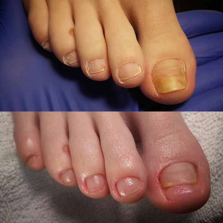 Vor und nach dem Auftragen der Creme brand exodermin marke von YesEnia