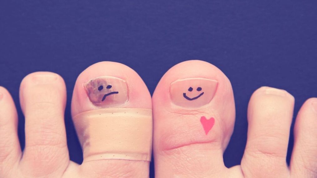 ein Nagel mit Pilz und ein gesunder